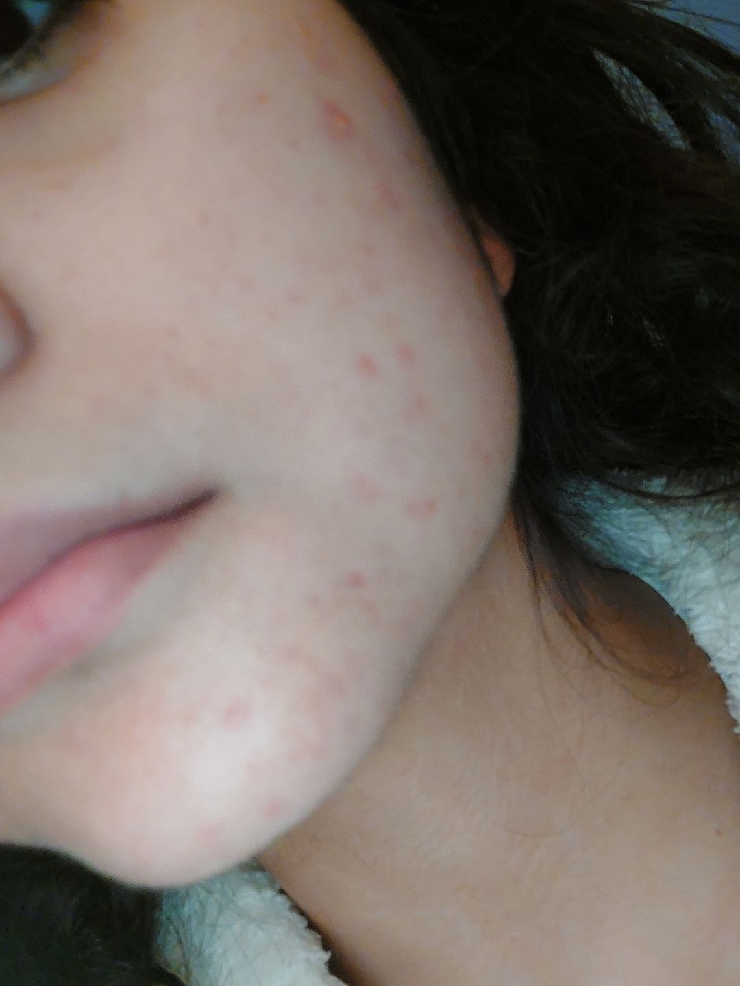 Customer photo review of Salicylsäure BHA 2% 40ml
