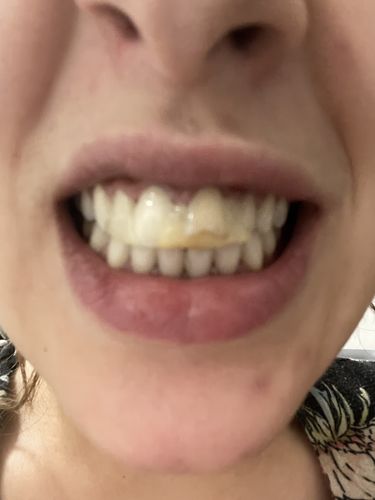 Customer photo review of PAP+ LED Teeth Whitening Kit