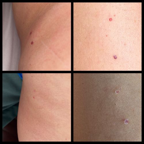 Customer photo review of Dermavel - Solo Kit