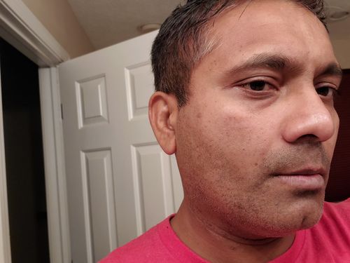 Customer photo review of Dermavel - Solo Kit