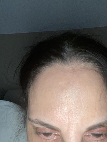 Customer photo review of WrinkleFix: Botox (Existing Customers)