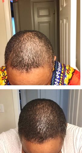 Customer photo review of Trio Set: African Black Soap Hair Growth Shampoo, Hair Growth Oil, and Hair Growth Conditioner