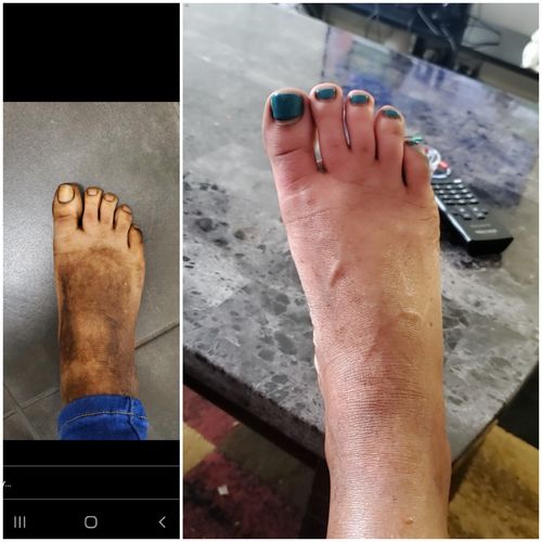 Customer photo review of Lightening Water Treatment (For Dark Hands & Feet)