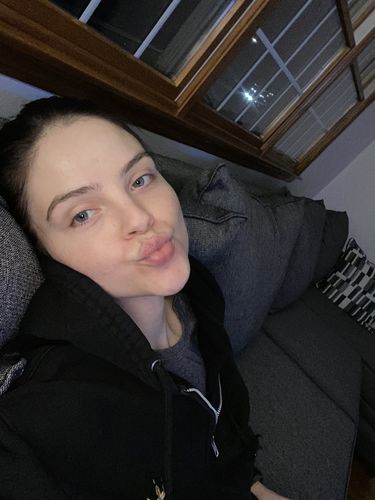 Customer photo review of WrinkleFix: Botox (Existing Customers)