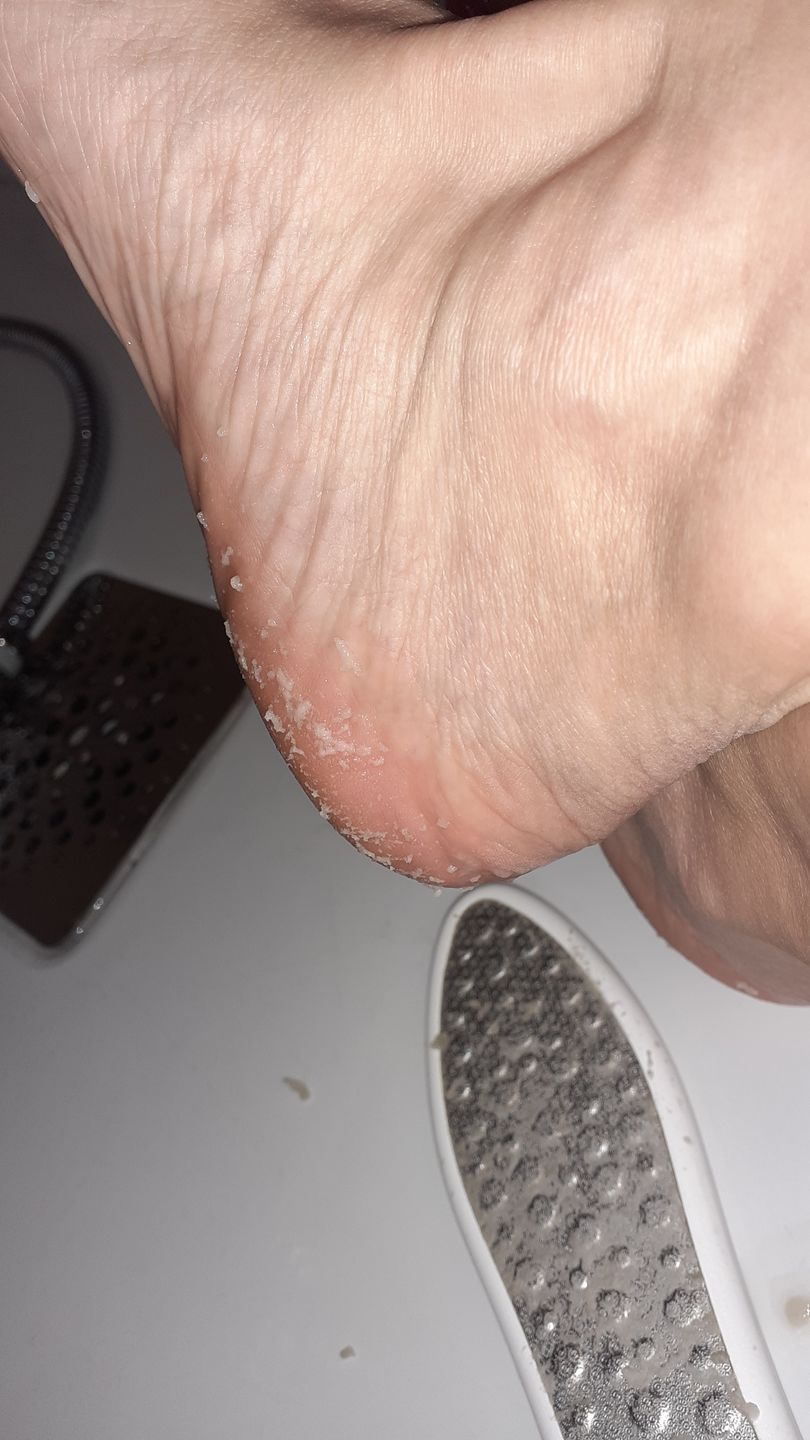 Customer photo review of LOVASKIN INSTANT FOOT PEEL Spray bottle 2.5 fl oz - 25 uses or under 2 $ to have beautiful feet