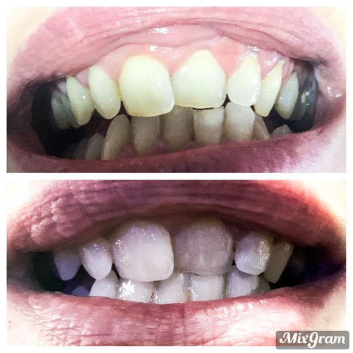 Customer photo review of Whites Non-Peroxide Teeth Whitening Kit