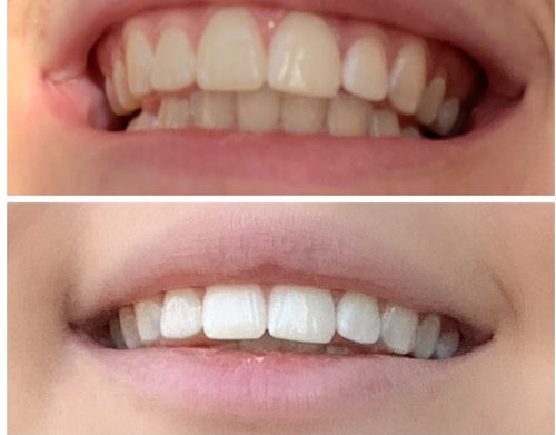 Customer photo review of Whites Non-Peroxide Teeth Whitening Kit