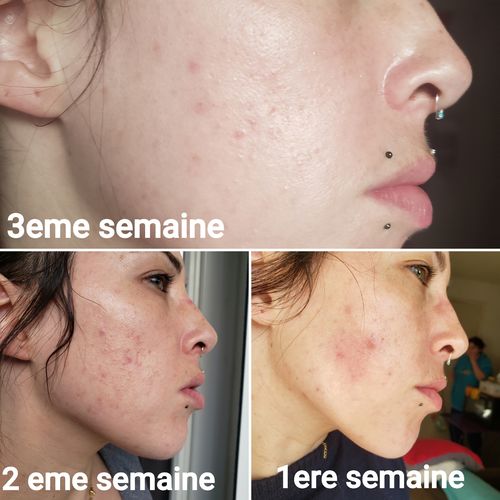 Customer photo review of ODERMIUM SKIN ACTIVE™Soin professionnelanti-acné reconstructeur