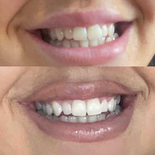 Customer photo review of Whites Non-Peroxide Teeth Whitening Kit