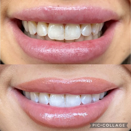 Customer photo review of Whites Non-Peroxide Teeth Whitening Kit