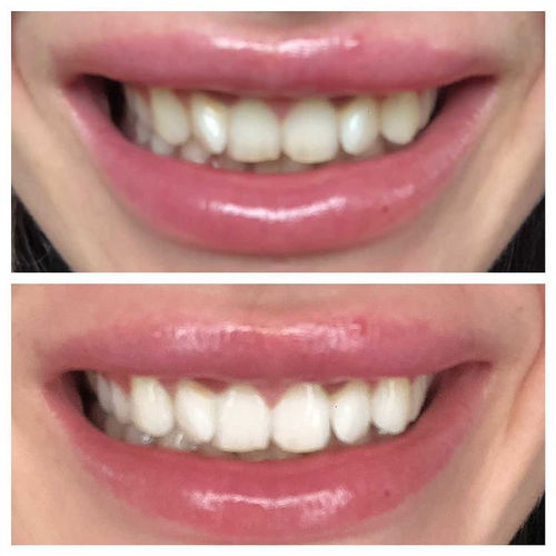 Customer photo review of Whites Non-Peroxide Teeth Whitening Kit