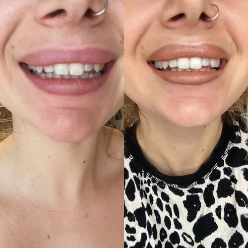 Customer photo review of Whites Non-Peroxide Teeth Whitening Kit