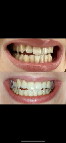 Customer photo review of Whites Non-Peroxide Teeth Whitening Kit