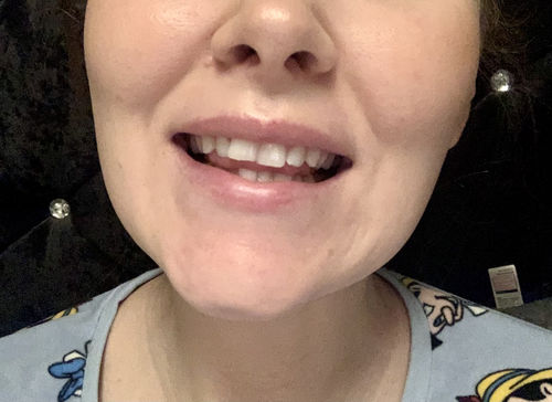 Customer photo review of Teeth Whitening Kit