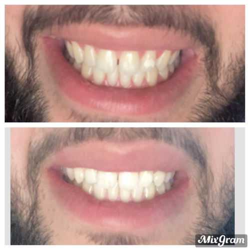 Customer photo review of Whites Non-Peroxide Teeth Whitening Kit