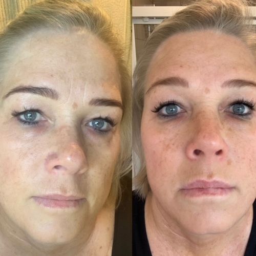 Customer photo review of HydraLift Eye Gel