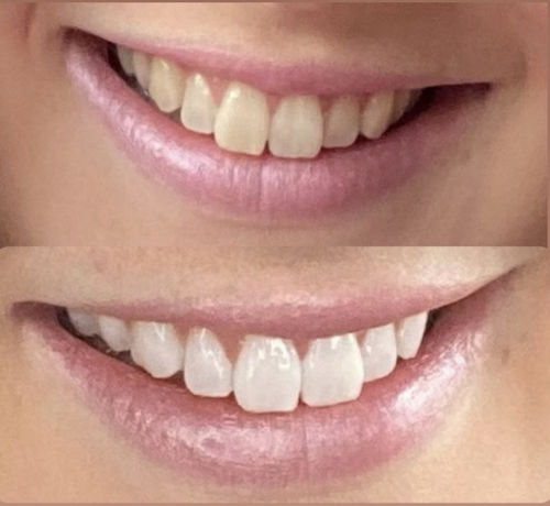 Customer photo review of Whites Non-Peroxide Teeth Whitening Kit