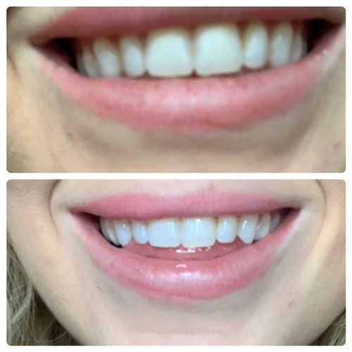 Customer photo review of Whites Non-Peroxide Teeth Whitening Kit