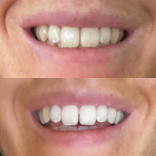 Customer photo review of Whites Non-Peroxide Teeth Whitening Kit