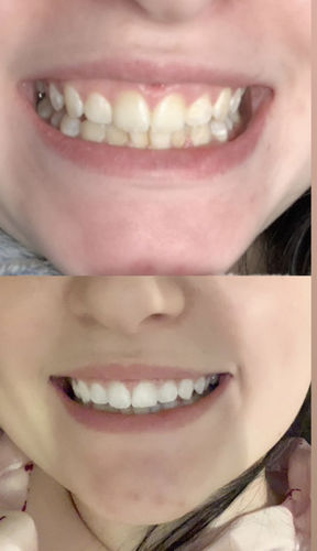 Customer photo review of Whites Non-Peroxide Teeth Whitening Kit