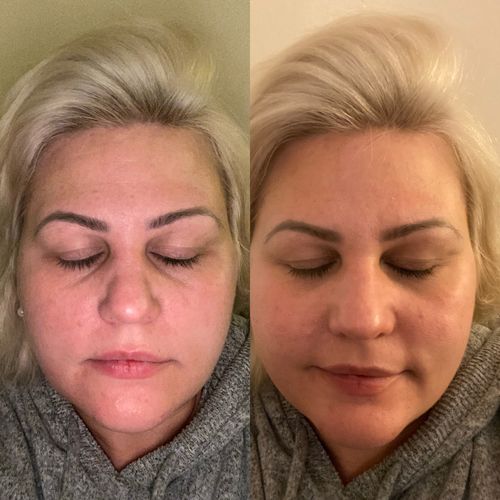 Customer photo review of Rosalique 3 in 1 Anti-Redness Miracle Formula SPF50