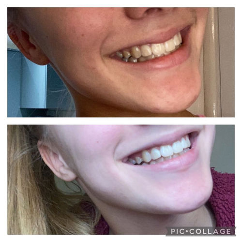 Customer photo review of Whites Non-Peroxide Teeth Whitening Kit