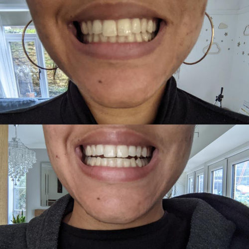 Customer photo review of Whites Non-Peroxide Teeth Whitening Kit
