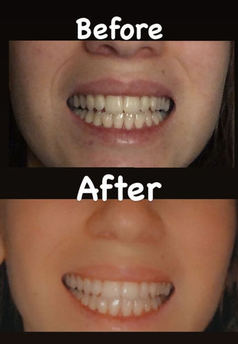Customer photo review of Whites Non-Peroxide Teeth Whitening Kit