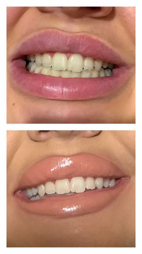 Customer photo review of Whites Non-Peroxide Teeth Whitening Kit