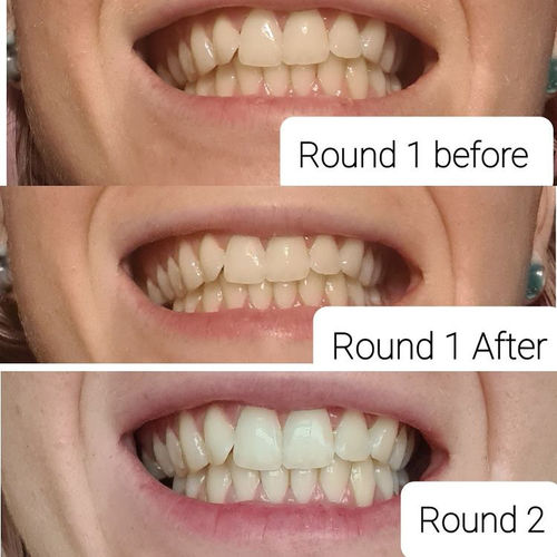 Customer photo review of Whites Non-Peroxide Teeth Whitening Kit