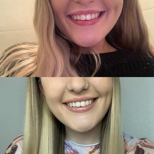 Customer photo review of Whites Non-Peroxide Teeth Whitening Kit