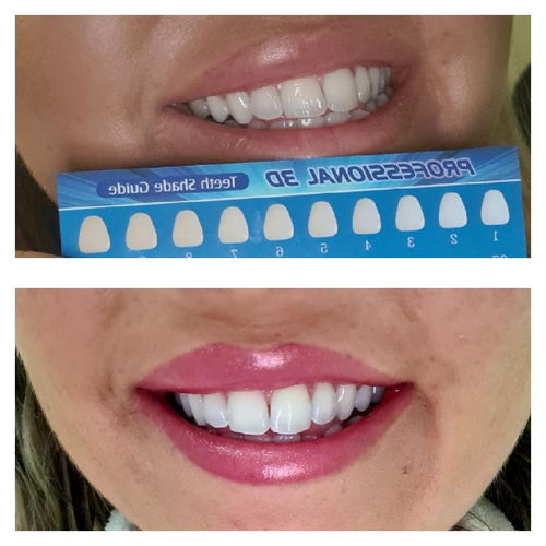 Customer photo review of Whites Non-Peroxide Teeth Whitening Kit