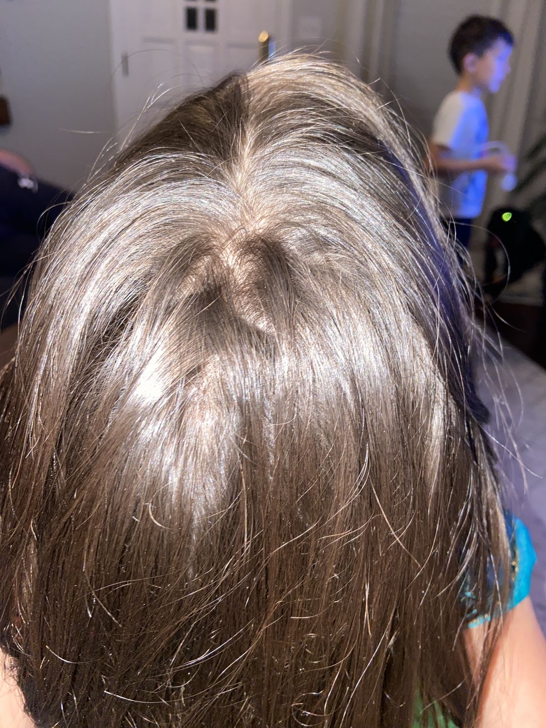 Customer photo review of Psoriasis Honey Scalp Nourishing Kit