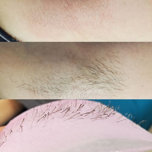 Customer photo review of Signature Series Hair Removal Wax