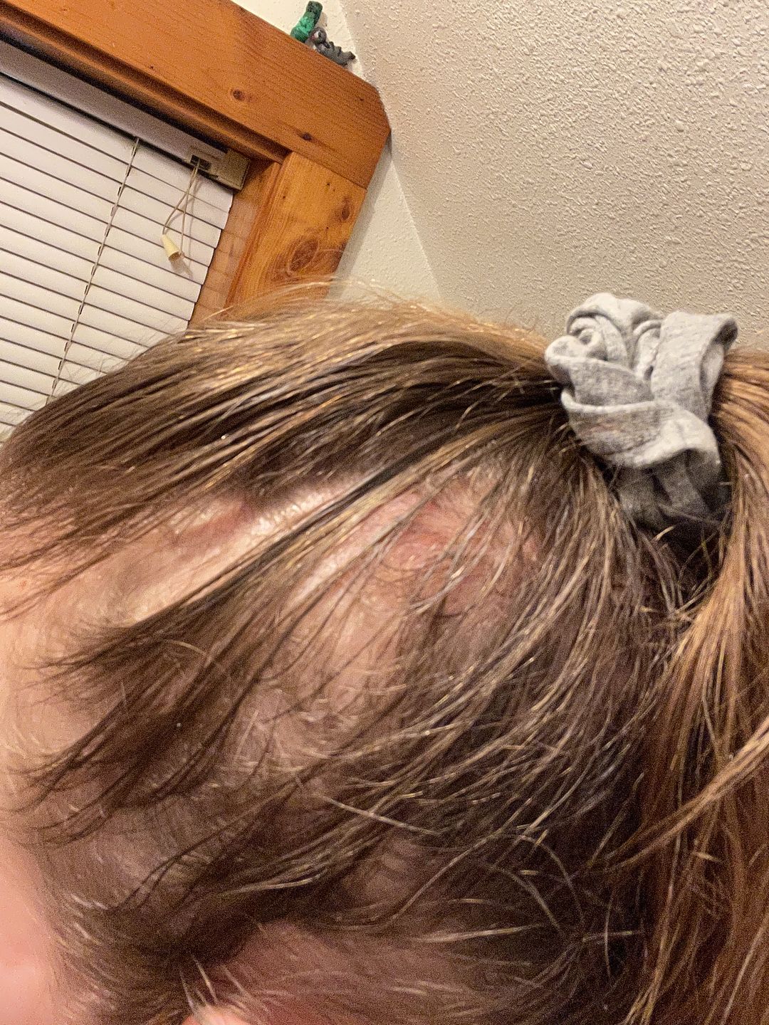 Customer photo review of Psoriasis Honey Scalp Nourishing Kit