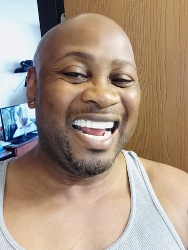 Customer photo review of Pop On Veneers with Impression Kit