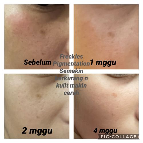 Customer photo review of Happiness box  - Scar & Brightening set