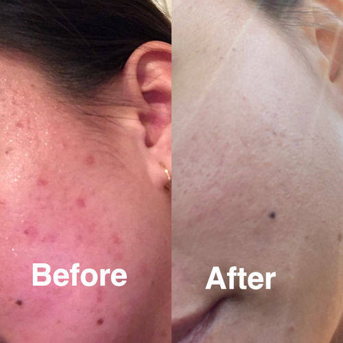 Customer photo review of Niacid