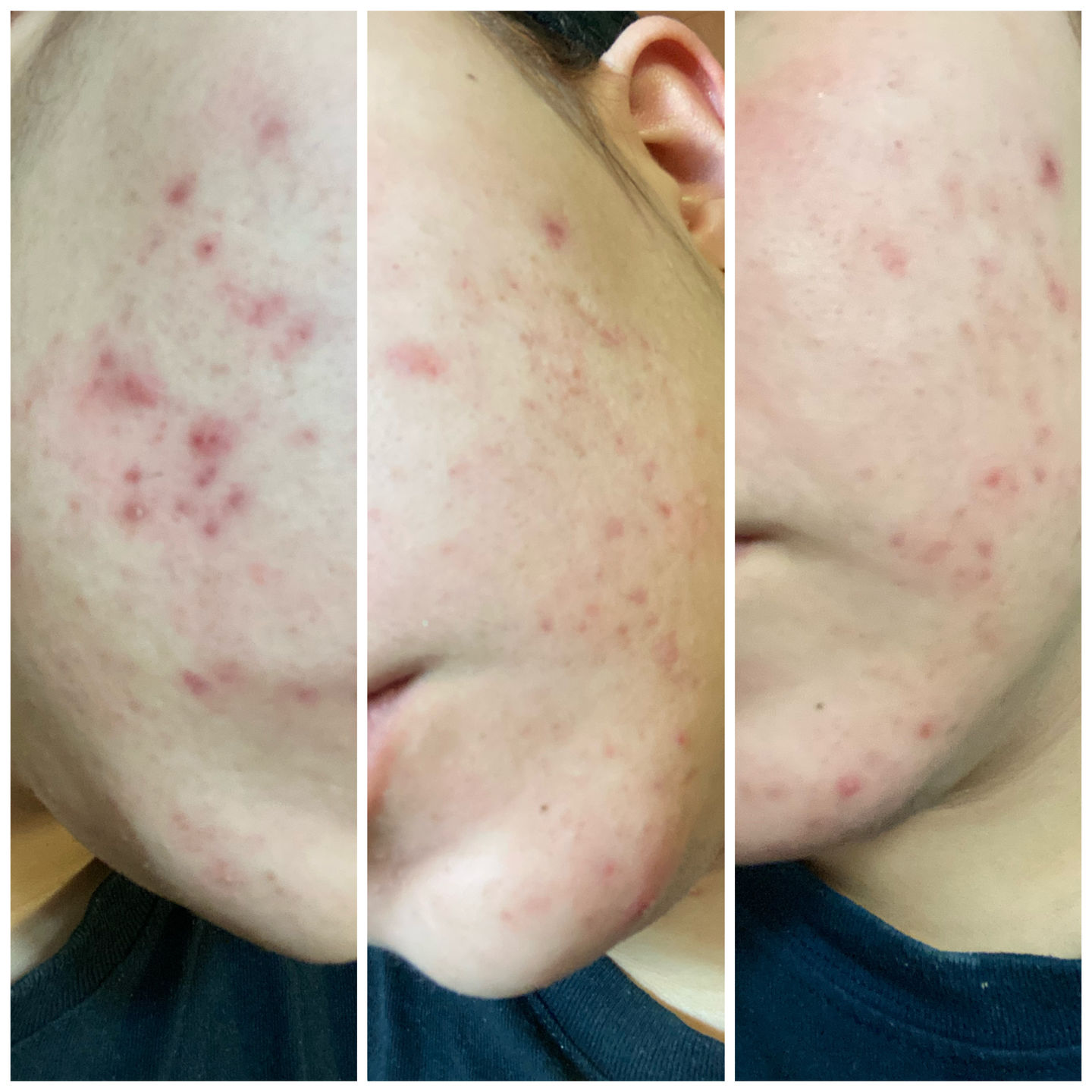 Customer photo review of Mask & Scrub / Mascarilla - Exfoliante de Tepezcohuite
