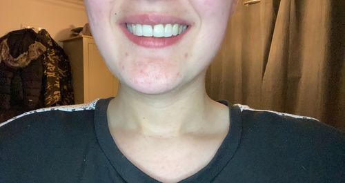 Customer photo review of Teeth Whitening Strips