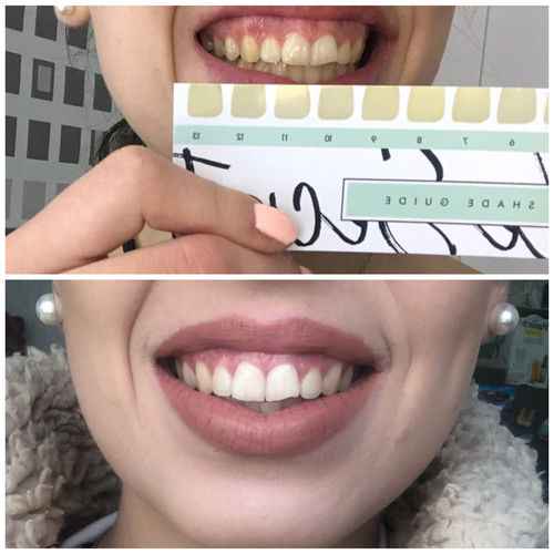Customer photo review of PAP+ LED Teeth Whitening Kit