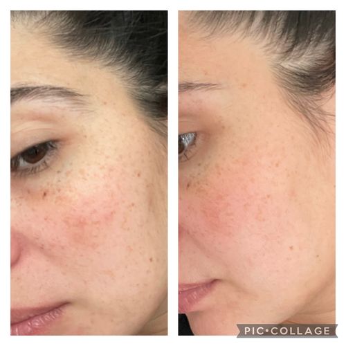 Customer photo review of Acne set