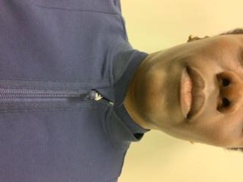 Customer photo review of JawlineFix: Filler