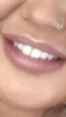 Customer photo review of Teeth Whitening Strips