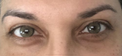 Customer photo review of Neala Green Contact Lenses(12 months wear)