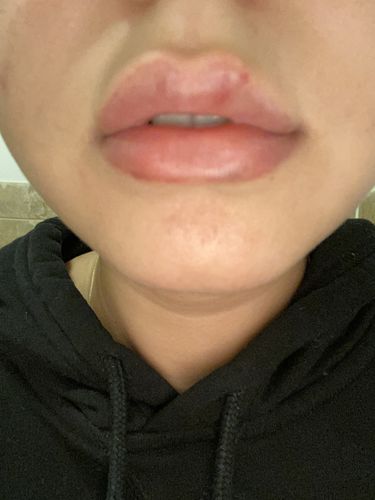 Customer photo review of LipFix: Filler