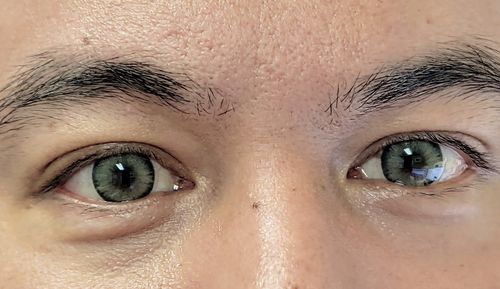 Customer photo review of Neala Green Contact Lenses(12 months wear)