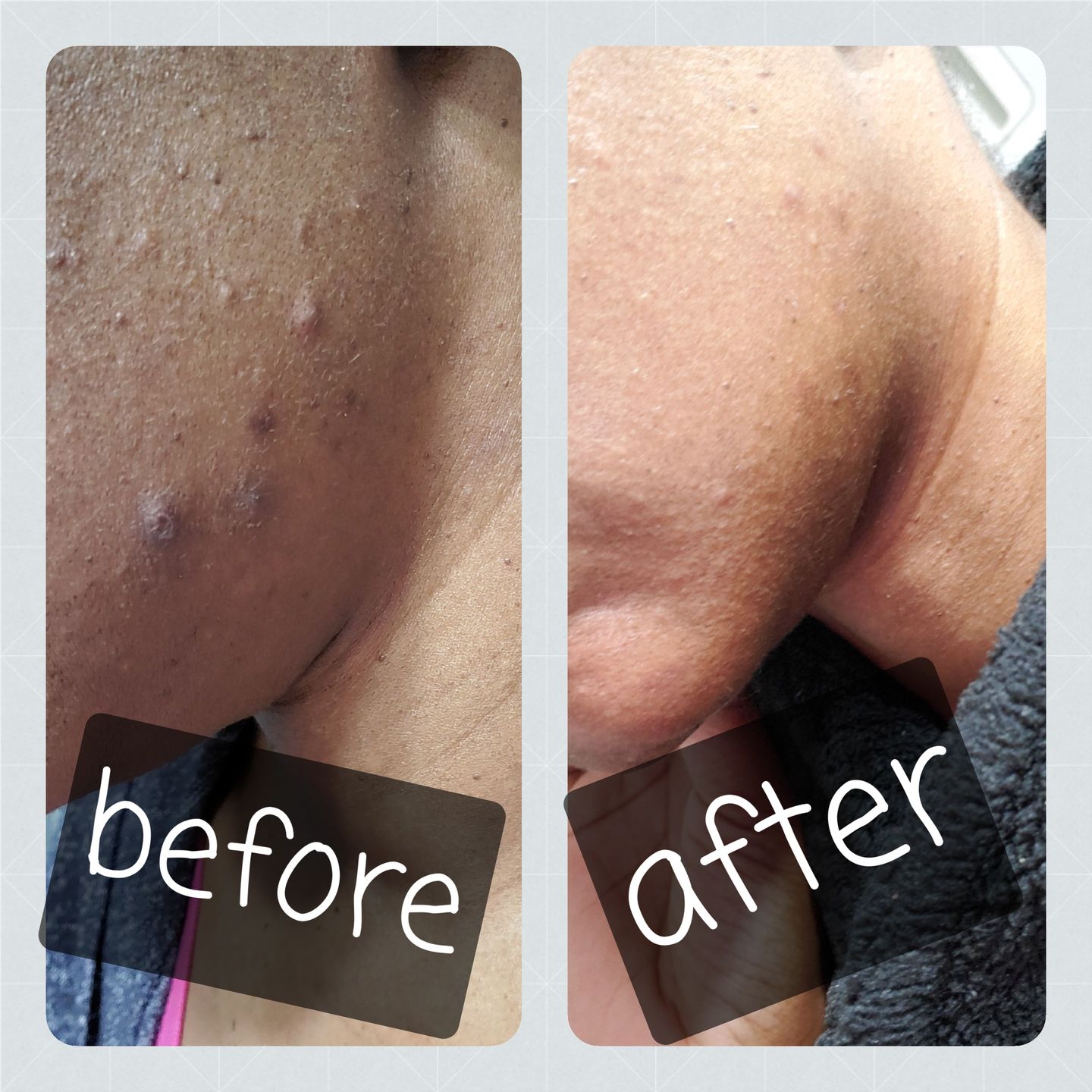 Customer photo review of Bolden Clear Skin Kit