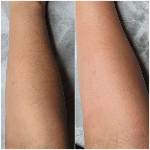Customer photo review of Signature Series Hair Removal Wax