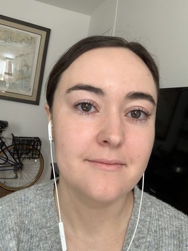 Customer photo review of WrinkleFix: Botox
